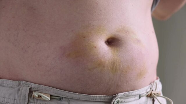 The man lifts his shirt to see and show the bruises on his stomach. Consequences of injections during treatment for coronavirus. Close-up.