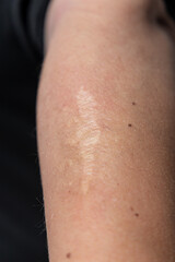 scar on a human forearm