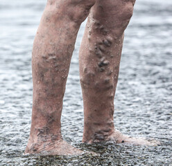 Large veins in the legs of an old man.