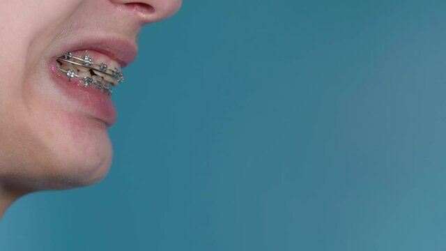 Closeup view 4k stock video footage of profile view of smiling mouth of young white teenage kid with overbite teeth and metal modern braces constructions on them. Face isolated at blue background