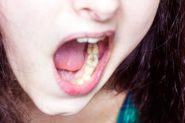 Young caucasian woman mouth with unhealthy teeth close up. Dental caries, toothache, tooth problems concept. - 428142586