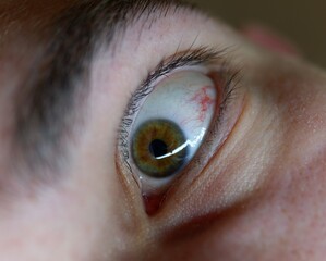 eye irritation