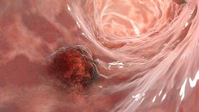 Intestinal carcinoma, colorectal cancer, bowel neoplasia, 3D illustration