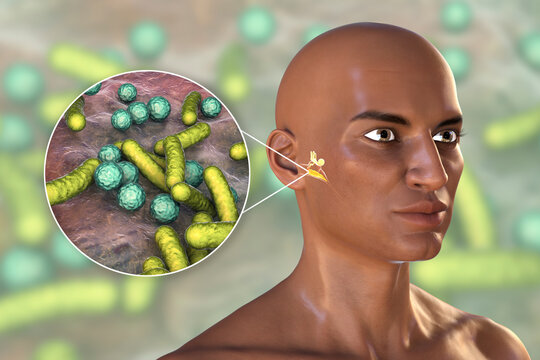 Otitis media, inflammatory disease of the middle ear, and closeup view of bacteria that cause otitis media