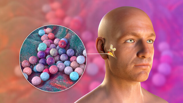 Staphylococcus aureus bacterium as a cause of otitis media