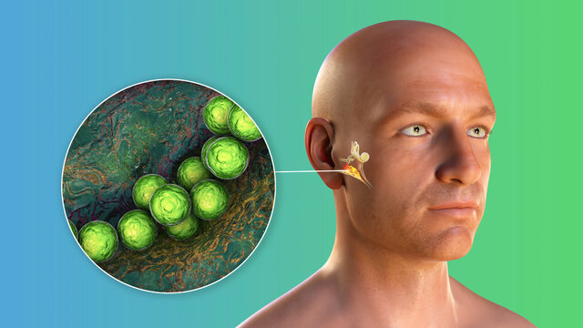 Streptococcus bacterium as a cause of otitis media