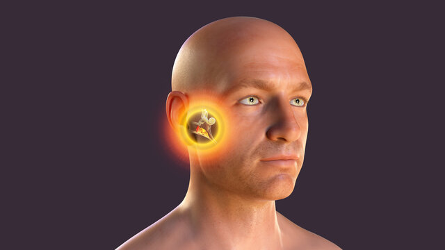 Otitis media, a group of inflammatory diseases of the middle ear, 3D illustration