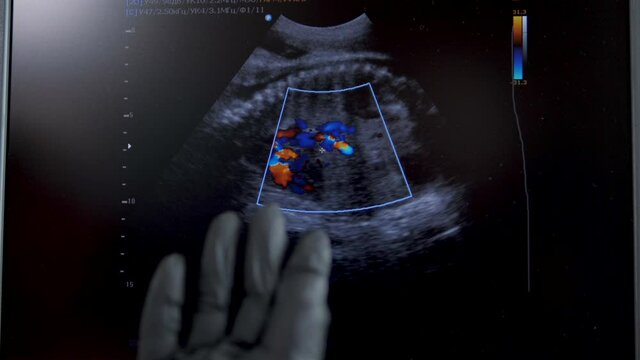 The doctor shows the monitor of the ultrasound machine, the doctor in gloves