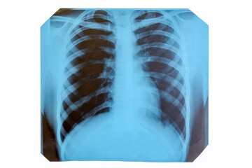 An isolated picture of an x-ray photograph of the chest and lungs during pneumonia