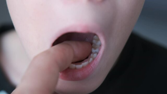 A baby tooth in the mouth of a ten-year-old boy, the man sways it with his hand. Open mouth closeup. Change of teeth in a teenager. Stomatology, dentistry concept for child.