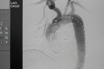 Angiogram of right common iliac artery after aortic stent graft deployed at infra renal abdominal...