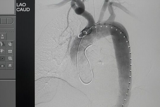 Angiogram Of Right Common Iliac Artery After Aortic Stent Graft Deployed At Infra Renal Abdominal Aortic Aneurysm During EVAR Procedure.