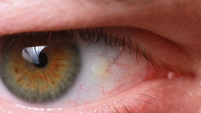 Pinguecula eyes macro video close-up of the male eye. Yellow education on squirrel, farmer's eye