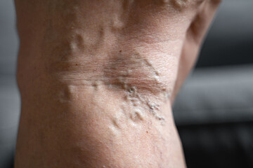 Varicose vein close up leg. Senior woman health problem. Foot with Diseased Veins. Health Care, Podiatry.