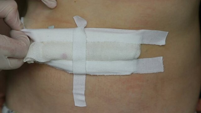Bandaging. Removal of gauze bandage for treatment of surgical sutures on child abdomen after surgery for umbilical and inguinal hernias.