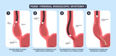 POEM Per oral surgery treat surgical GERD tract lower food damage nerves acid reflux pain barium swallow motility balloon diffuse spasm outflow upper biopsy heller