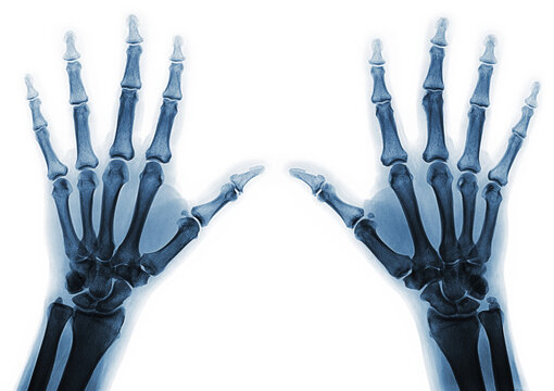 X-rays of hands of an adult man with visible damage