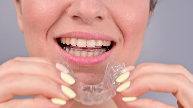 Close-up portrait of Caucasian woman taking off transparent night-time retainers. Bite correction with removable braces
