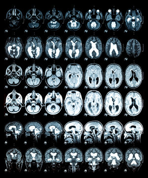 MRI scan or magnetic resonance image of the brain showed obstructive triventricular hydrocephalus. Medical service concept.