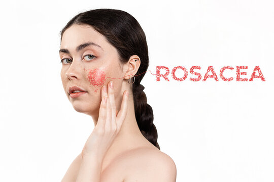 Cosmetology and dermatology. Portrait of a young, beautiful woman with painted red cheek. White background with rosacea text. Concept of treatment of couperose