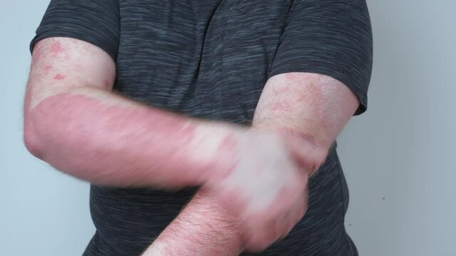 A guy smears his hands with ointment, his hands covered with psoriasis, which itch very much, the concept of psoriasis, eczema and other diseases of dry skin