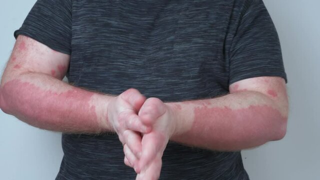 A guy smears his hands with ointment, his hands covered with psoriasis, which itch very much, the concept of psoriasis, eczema and other diseases of dry skin
