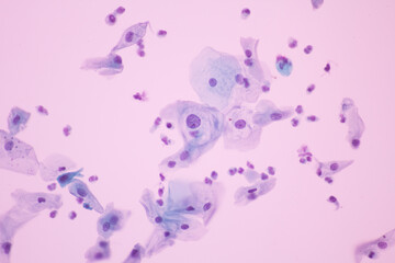 View in microscopic of Abnormal human cervix cells.Squamous epithelium cells.Superficial and intermediate epithelial cells.Cytology and pathology laboratory department.Magnification 400 X