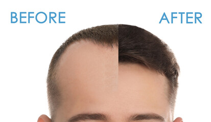 Closeup view of man before and after hair loss treatment on white background, collage. Banner design