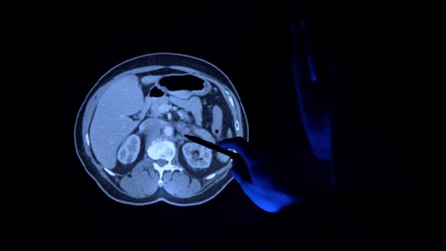 Doctor with a pen checking a tomography scan of the prostate with cancer tumor. Medical diagnostic of the prostate to prevent prostate cancer. X-ray. Tomography MRI, CT examining in 4k video.
