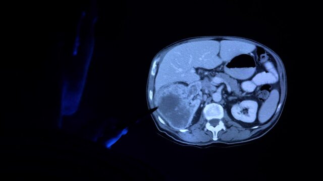 Doctor with a pen checking a tomography scan of the kidney with cancer tumor. Medical diagnostic of the kidneys to prevent kidney cancer. Renal cell cancer. X-ray. Tomography MRI, CT examining in 4k.