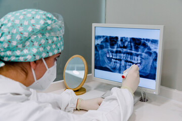 Female dentist with an x-ray on the computer pointing out the molars to be extracted.