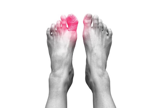 Top view picture of two bare human female feet with a wounded big toe healed with bandage for medical care. Isolated on white background . Black and white tone with red spot on bandage