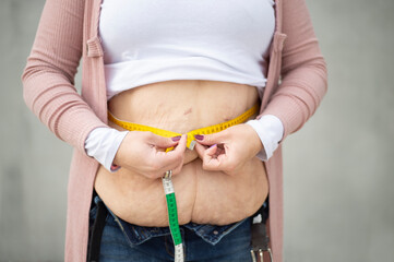 Ein neues Lebensgefühl. Eine Frau hat viel Gewicht nach einer Magenverkleinerung verloren. Auf dem Foto sieht man den immer noch sehr großen Bauch