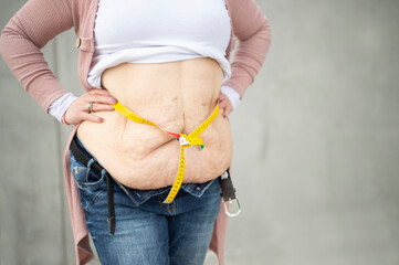 Ein neues Lebensgefühl. Eine Frau hat viel Gewicht nach einer Magenverkleinerung verloren. Auf dem Foto sieht man den immer noch sehr großen Bauch