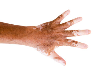 Close-up Vitiligo on skin hands of old people. medical condition causing depigmentation of patches of skin. isolated White background