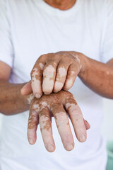 Fototapeta premium Close-up Vitiligo on skin hands of old people. medical condition causing depigmentation of patches of skin