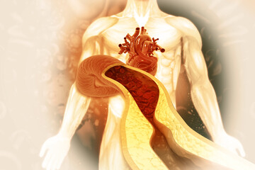 Cholesterol plaque in artery.3d illustration