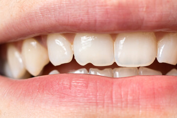 Macro close-up of human teeth. Shows the chipped tooth. The effect of the cutter's tooth from...