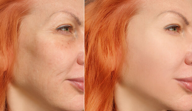 woman face wrinkles before and after treatment