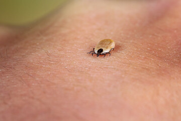 Engorged tick on a human skin. Lyme disease caused by borrelia.