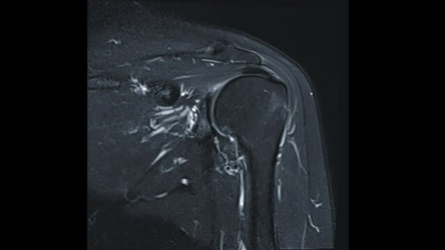 MRI Shoulder joint or Magnetic resonance imaging of Shoulder Joint Coronal T2W for diagnosis arthritis and including tears and impingement.