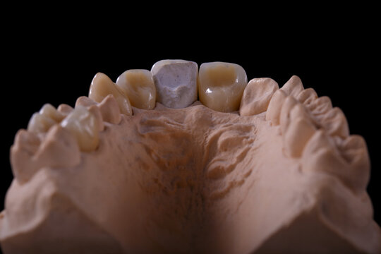 Mold of teeth. Gypsum model plaster of teeth. Plaster cast of teeth from human in preparation for producing a dental crown. Dentistry and orthodontics concept