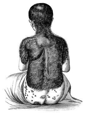 Rear view of a four year old partially hairy child. Hypertrichosis. Illustration of the 19th century. Germany. White background.