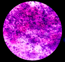 View in microscopic of human cervix cells. Squamous epithelial cells. Pap smear. pap's. cervical...