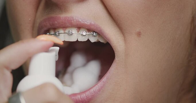 Teeth and braces cleaning. Close up of woman brushing oral cavity by cleansing foam toothpaste. Dental hygiene
