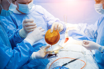 Breast augmentation under the guidance surgeons team in surgical operating room.