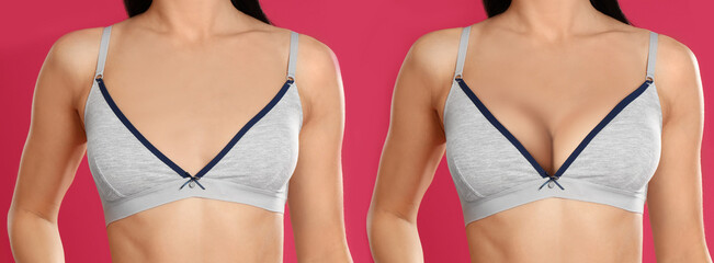 Collage with photos of young woman before and after breast size correction on color background,...