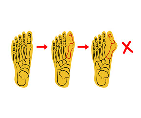 Human foot. Improper bone fusion. Symbol. Vector illustration.