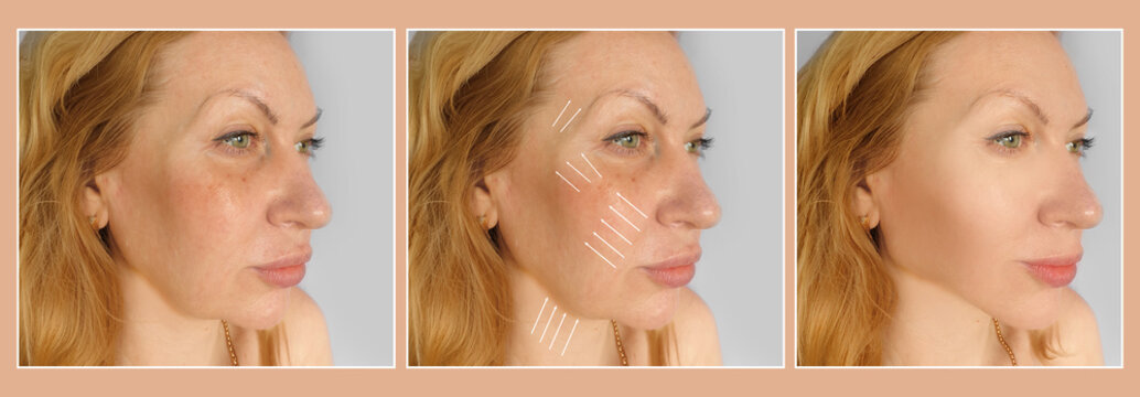 woman face wrinkles before and after treatment