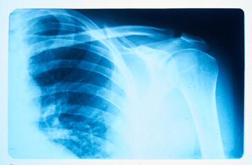 Image of x-ray film of human shoulder joint front view, taken to see injuries of tendons and bones for a medical diagnosis
